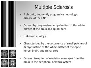 Nursing Considerations for Multiple Sclerosis