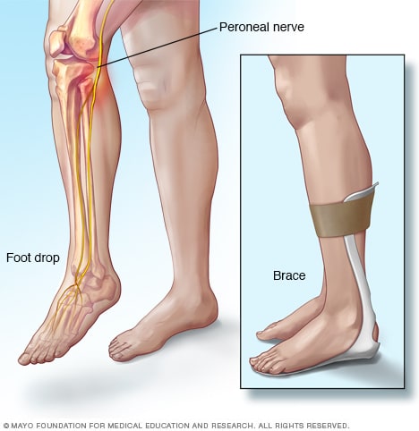 Nursing Considerations for Patients with Foot Drop