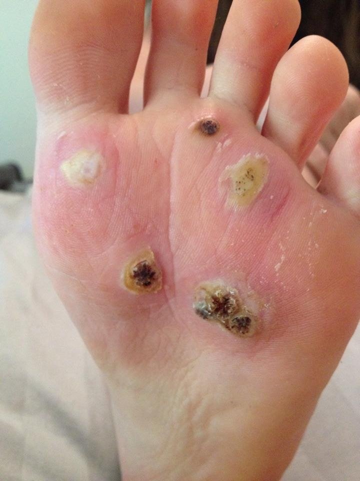 Nursing Considerations for Plantar Warts