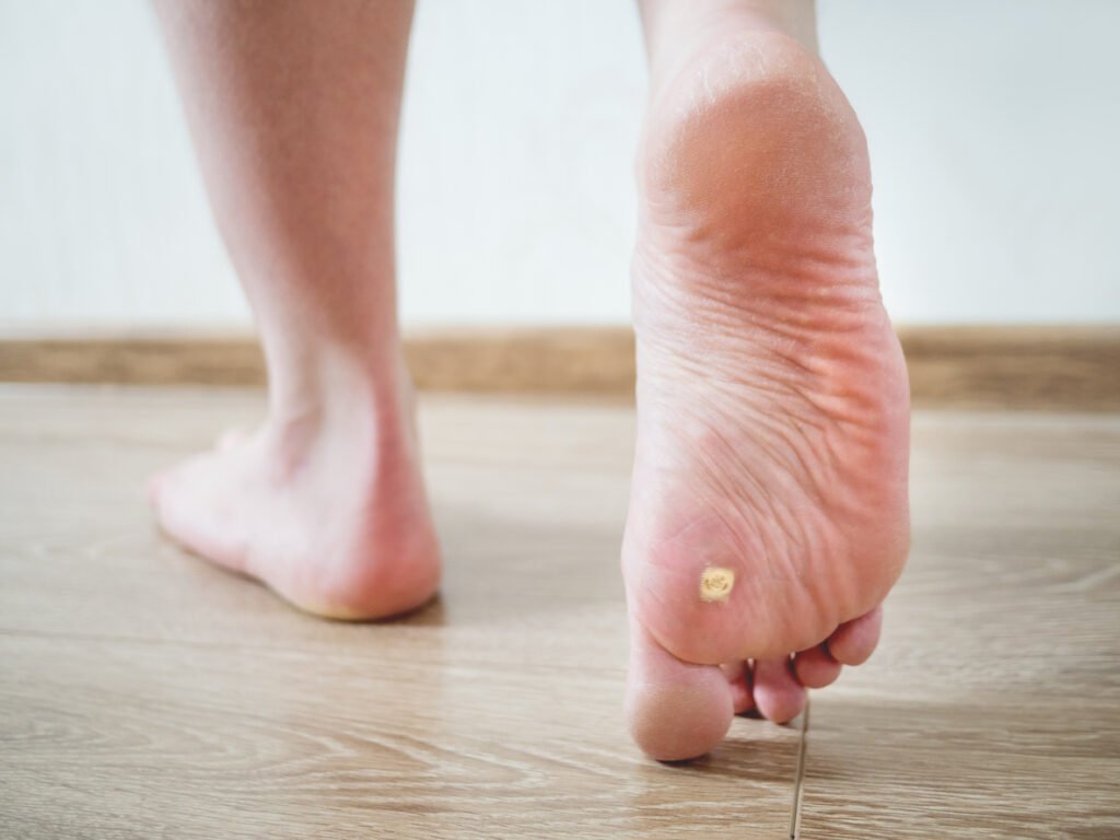 Nursing Considerations for Plantar Warts