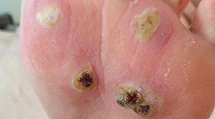 Nursing Considerations for Plantar Warts