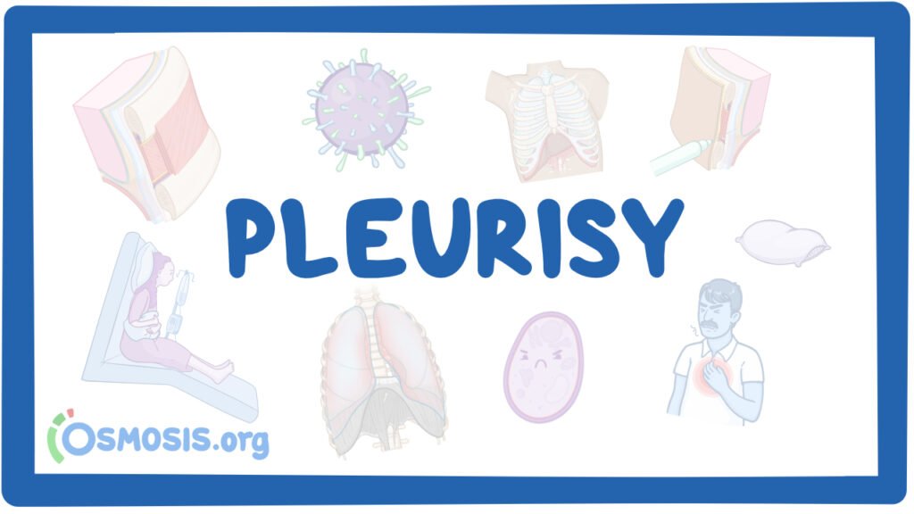 Nursing Considerations for Pleurisy