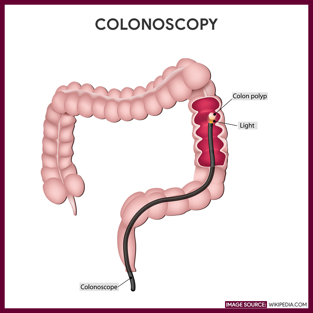 Nursing Considerations for Polyps-Colon