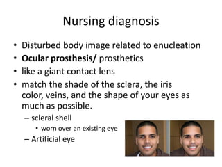 Nursing Considerations for Prosthetic Eye