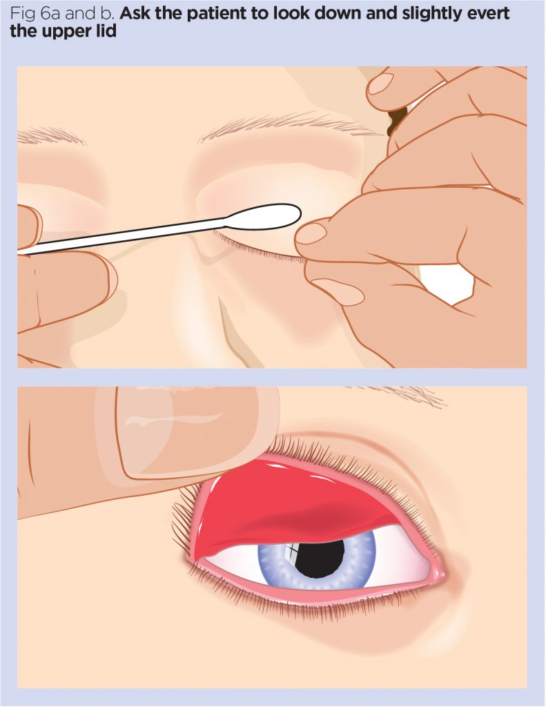 Nursing Considerations for Prosthetic Eye
