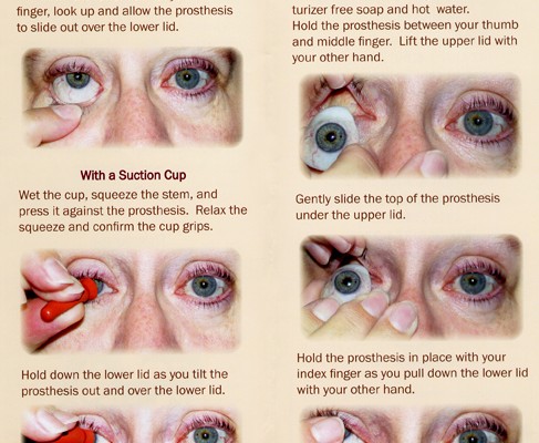 Nursing Considerations for Prosthetic Eye