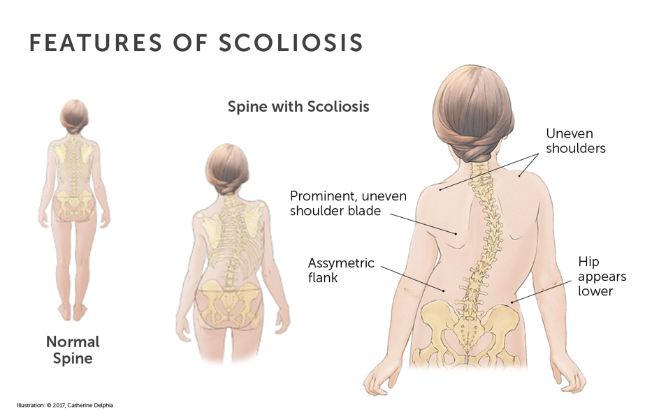 Nursing Considerations for Spine Curvature Disorders