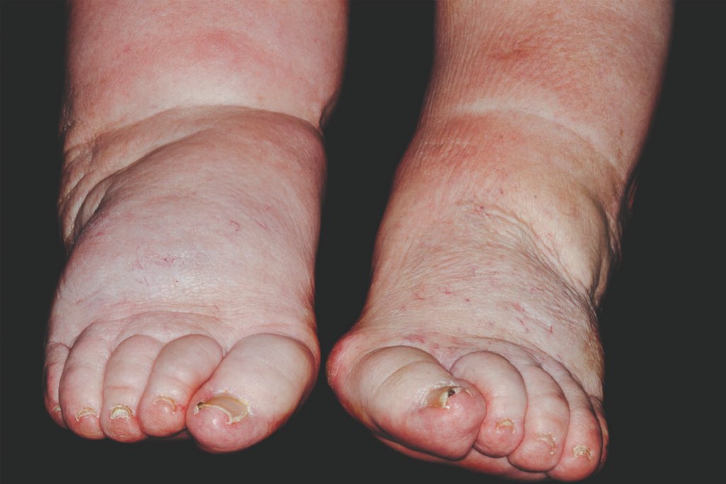 Nursing Considerations for Swollen Feet or Ankles