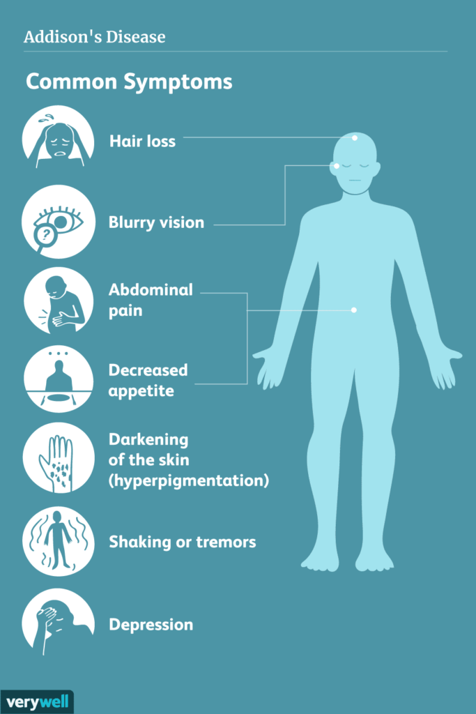 Preventing and Managing Addisons Disease Complications Preventing and Managing Addisons Disease Complications