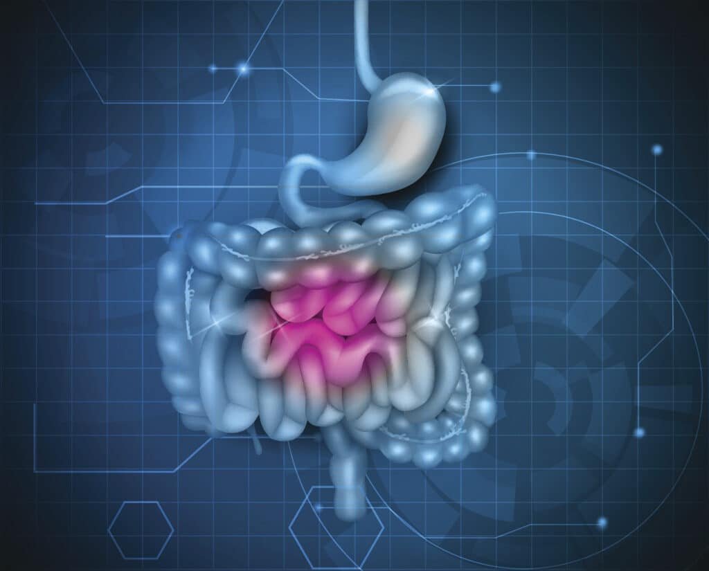Preventing and Managing Leaky Gut Syndrome