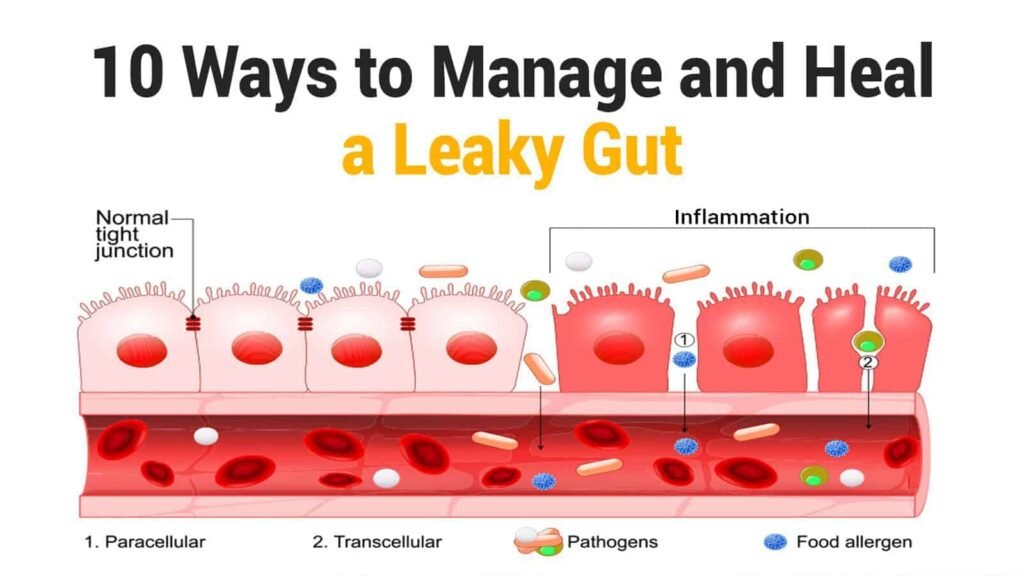 Preventing and Managing Leaky Gut Syndrome