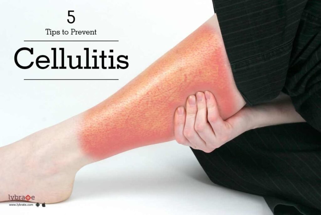 Preventing Cellulitis: Tips for Healthy Skin