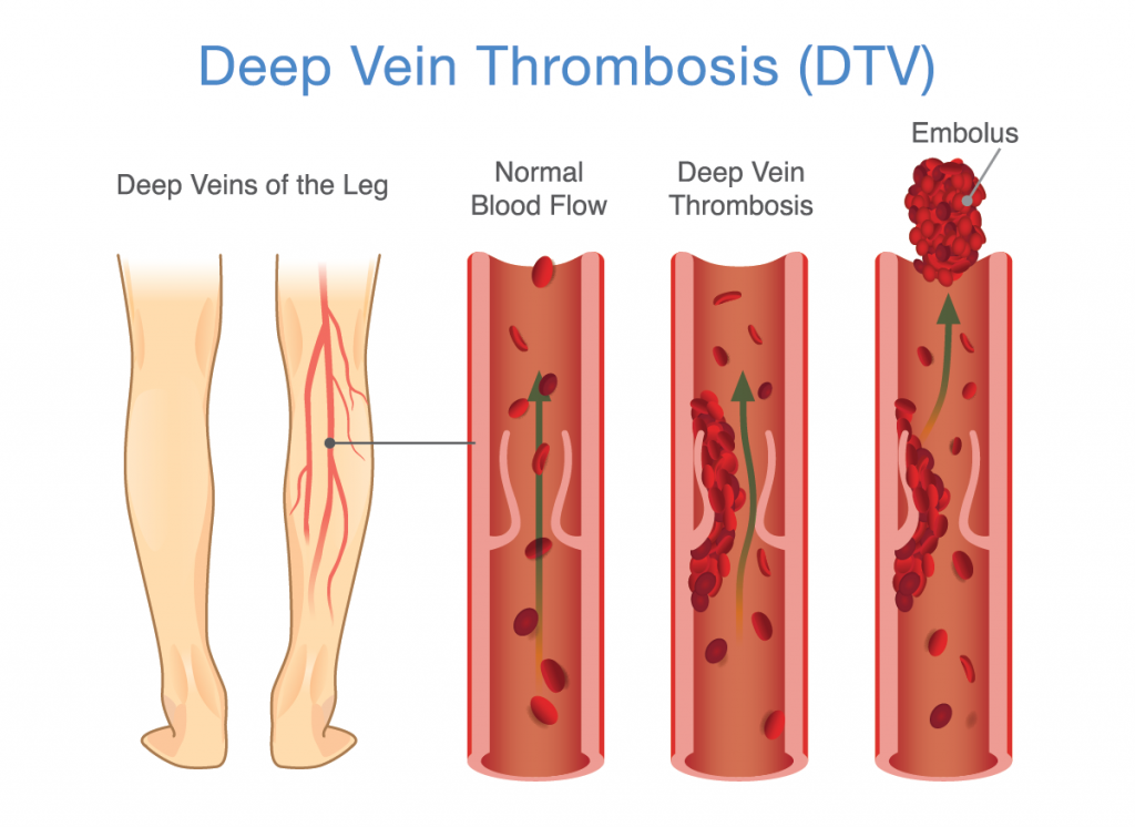 Preventing Deep Vein Thrombosis