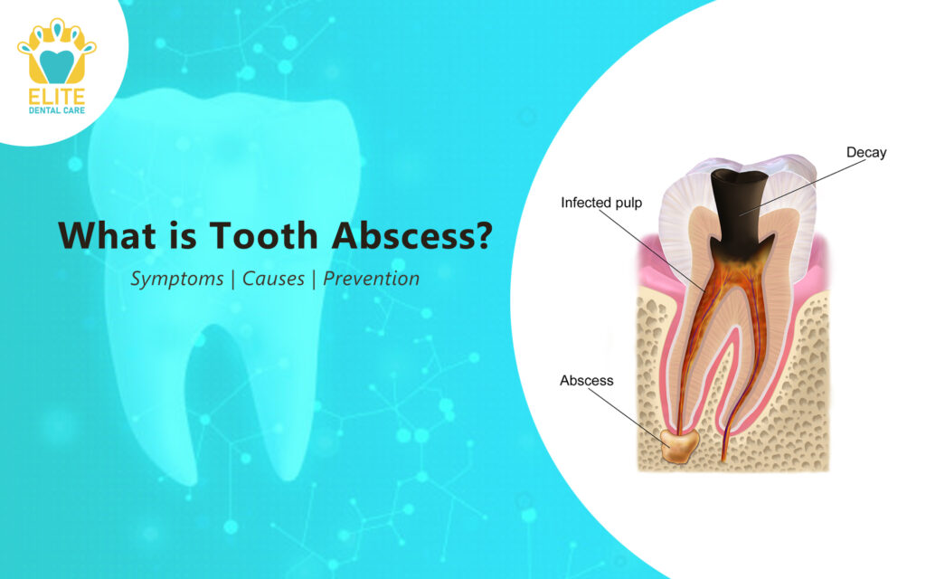 Preventing Dental Abscesses Preventing Dental Abscesses
