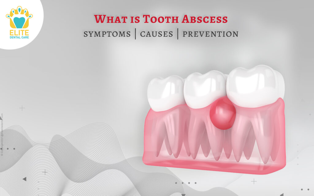 Preventing Dental Abscesses Preventing Dental Abscesses
