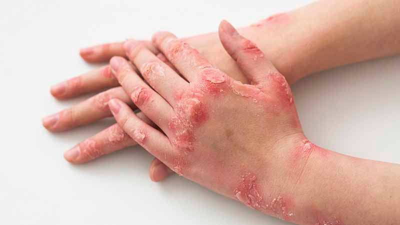 Preventing Eczema Flare-Ups: Practical Strategies Preventing Eczema Flare-Ups: Practical Strategies