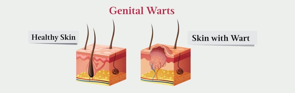 Preventing Genital Warts: Tips and Strategies