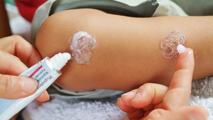 Preventing Impetigo: Effective Strategies and Tips