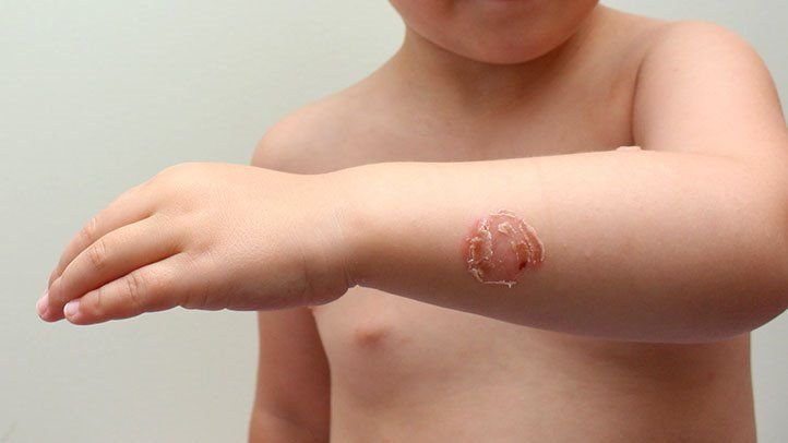 Preventing Impetigo: Effective Strategies and Tips