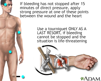 Preventing Internal Bleeding: Key Steps to Take Preventing Internal Bleeding: Key Steps to Take