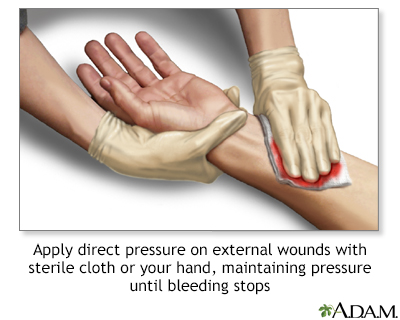 Preventing Internal Bleeding: Key Steps to Take Preventing Internal Bleeding: Key Steps to Take