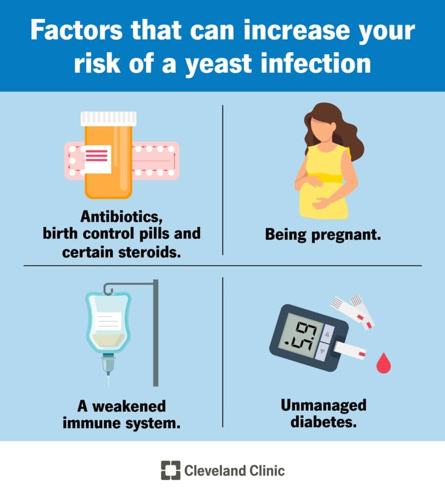 Preventing Yeast Infection: Key Tips