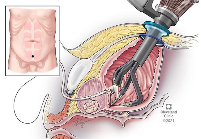 Promising Research Advances in BPH Treatment