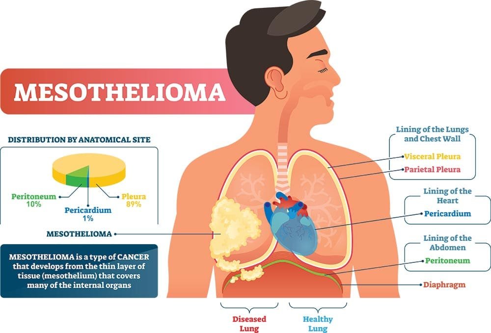 Raising Awareness about Asbestos-Induced Cancer