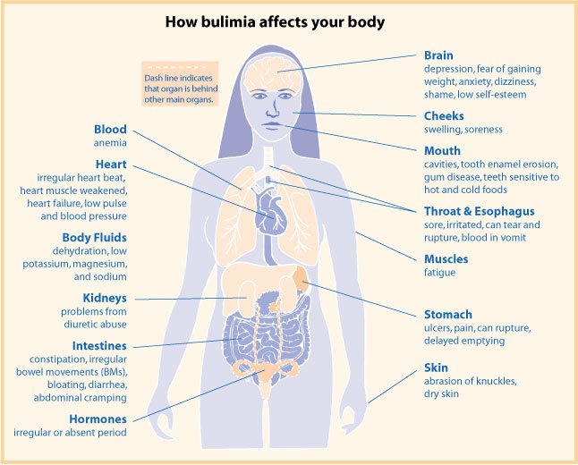 Recognizing the Signs of Bulimia Nervosa