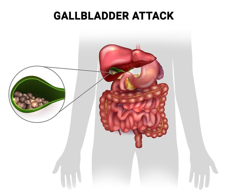 Recognizing the Symptoms of Gallstones