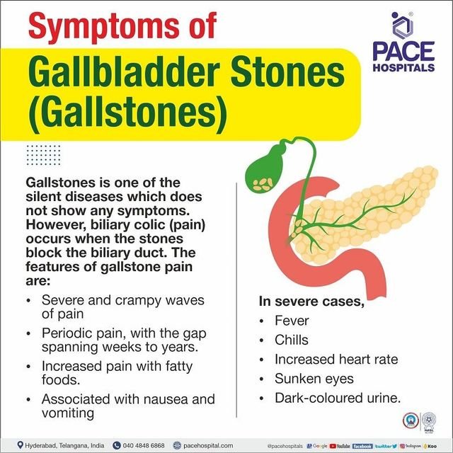 Recognizing the Symptoms of Gallstones