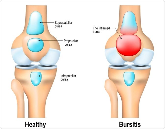 Relieving Pain from Bursitis: Effective Home Remedies