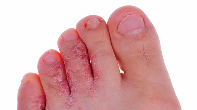 Risk Factors And Precautions For Athletes Foot