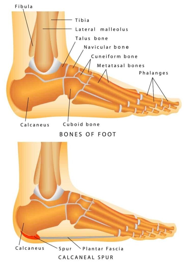 Risk Factors And Precautions For Bone Spurs