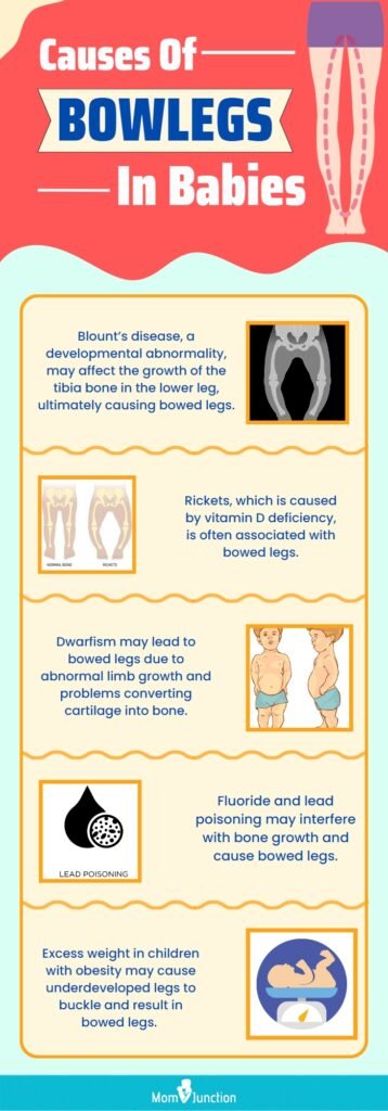 Risk Factors And Precautions For Bow Legs