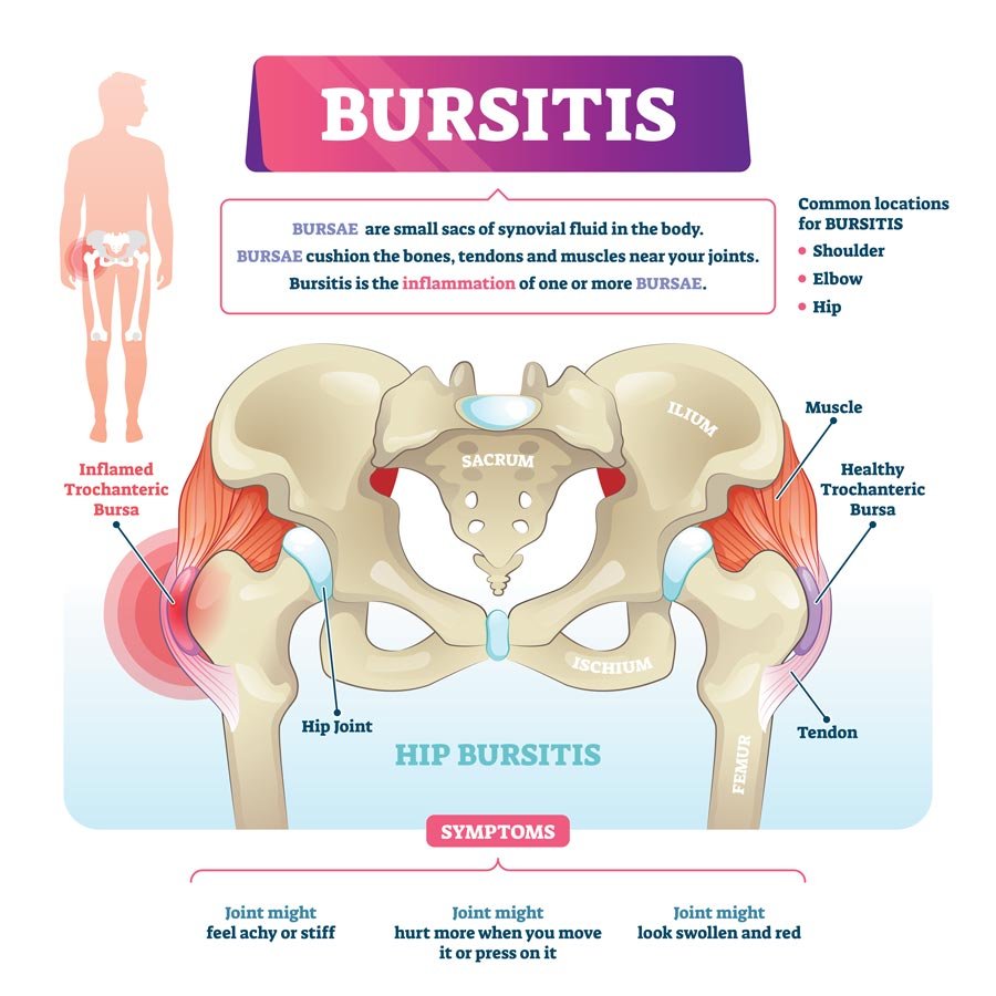Risk Factors And Precautions For Bursitis
