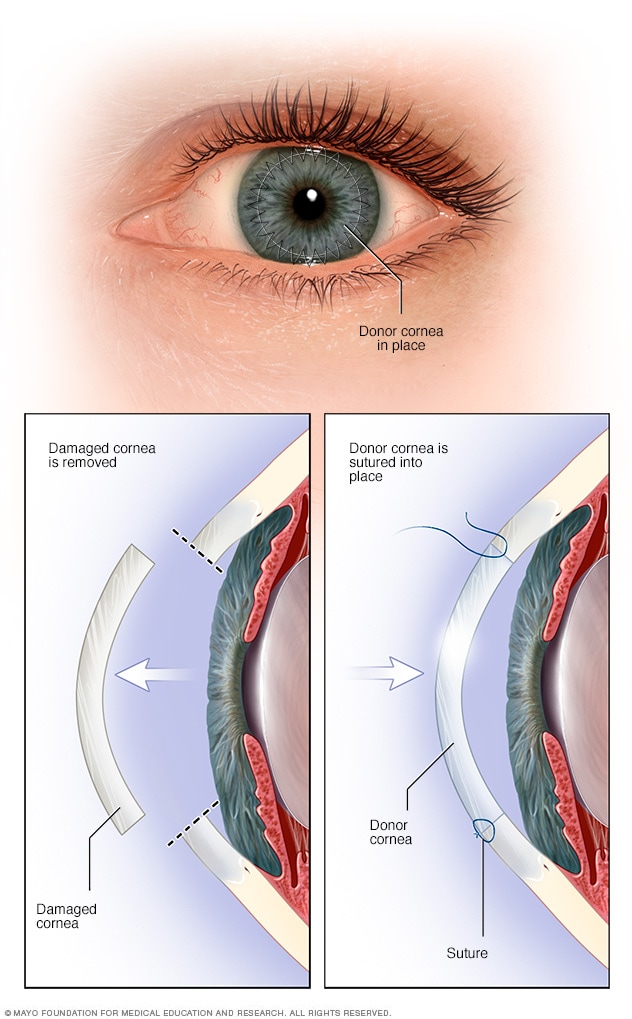 Risk Factors And Precautions For Cornea Transplant