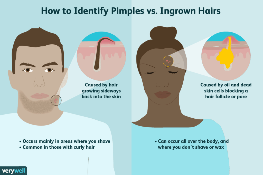 Risk Factors And Precautions For Ingrown Hair