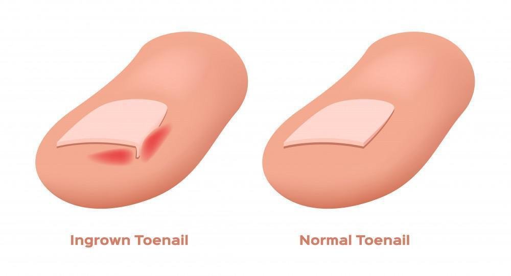 Risk Factors And Precautions For Ingrown Toenail