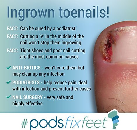Risk Factors And Precautions For Ingrown Toenail