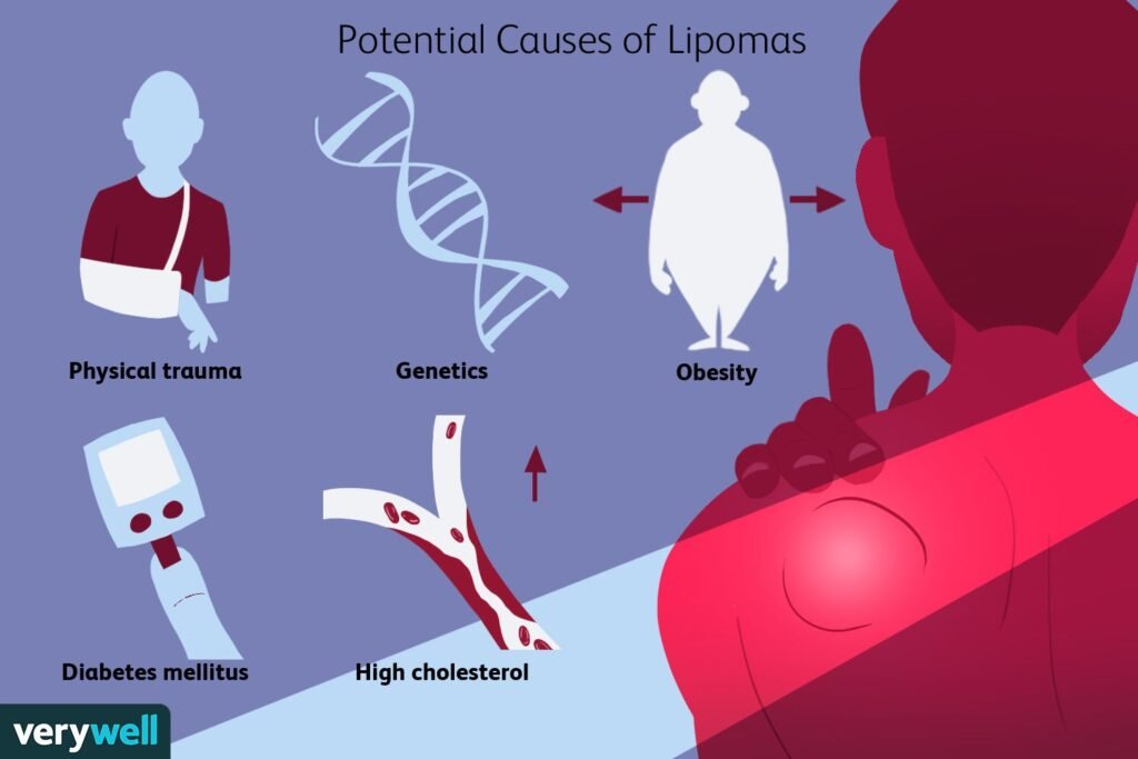 Risk Factors And Precautions For Lipoma