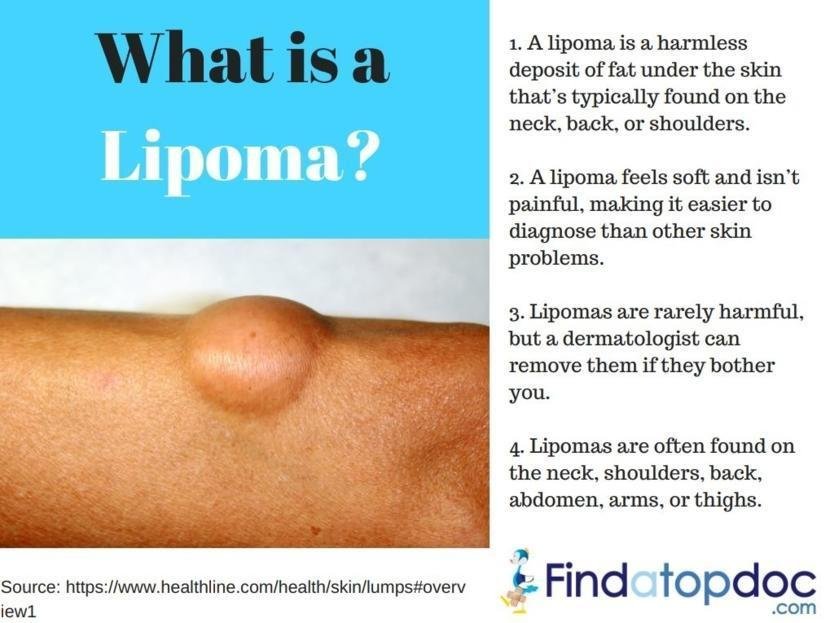 Risk Factors And Precautions For Lipoma