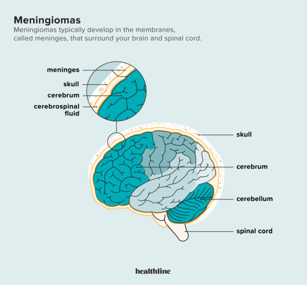 Risk Factors And Precautions For Meningioma