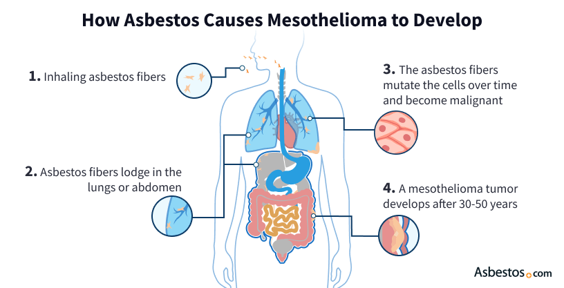 Risk Factors And Precautions For Mesothelioma