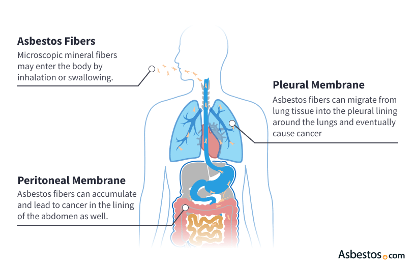 Risk Factors And Precautions For Mesothelioma