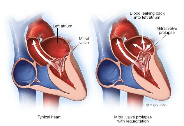 Risk Factors And Precautions For Mitral Valve Prolapse