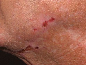 Risk Factors And Precautions For Morgellons