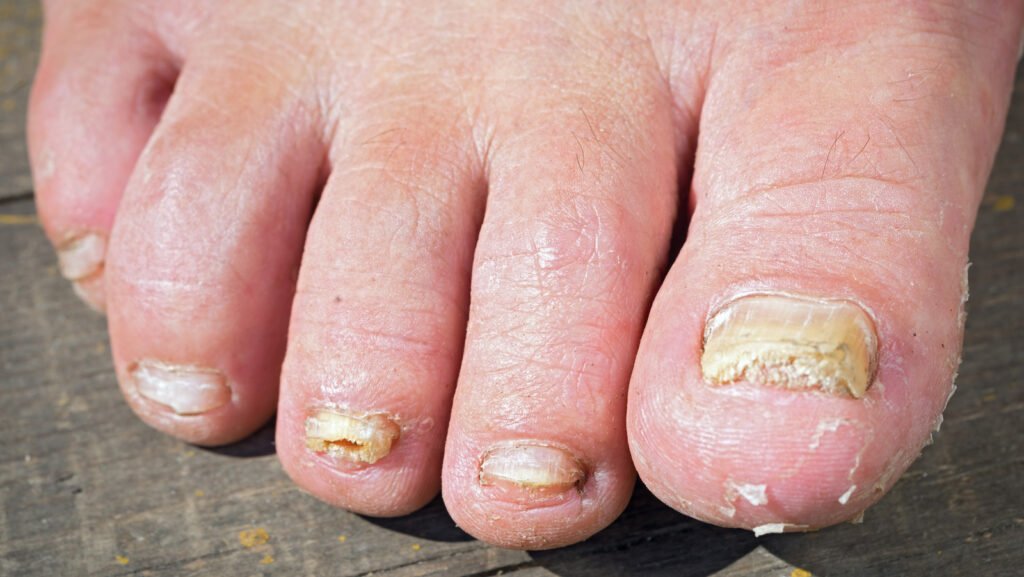 Risk Factors And Precautions For Nail Fungus