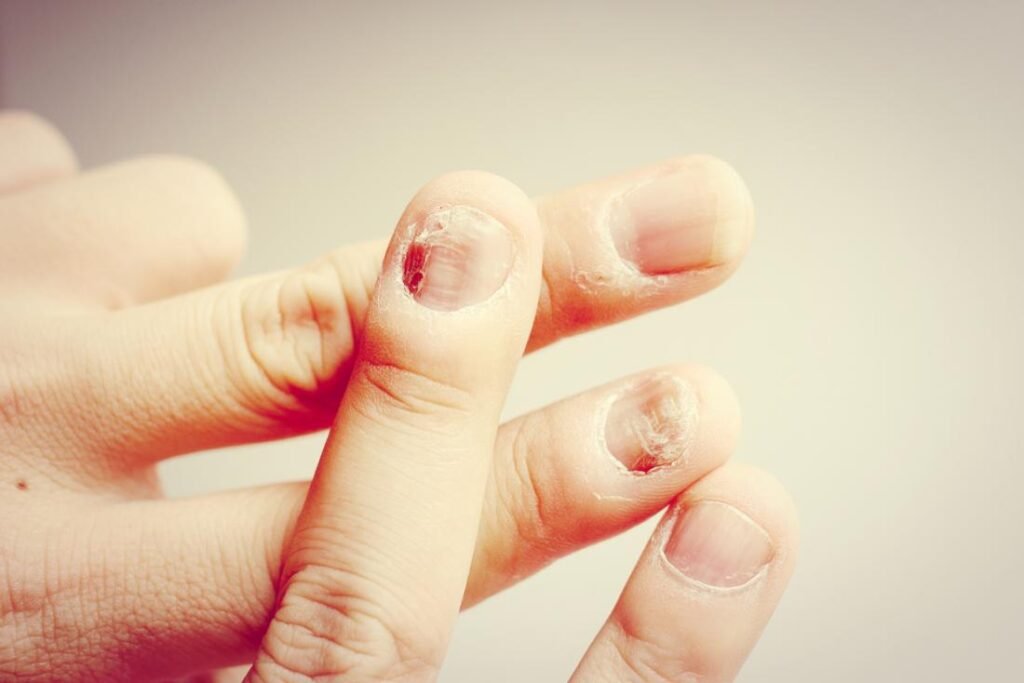 Risk Factors And Precautions For Nail Fungus