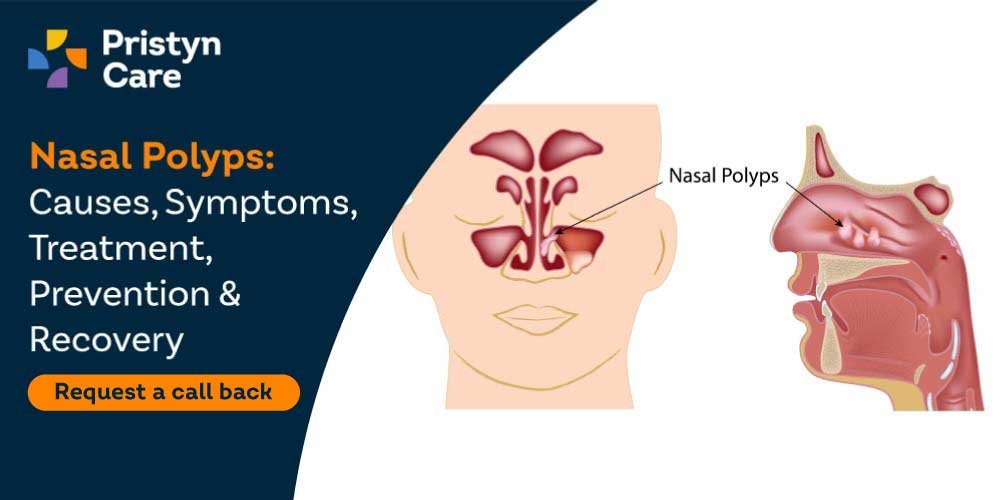 Risk Factors And Precautions For Nasal Polyps
